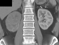 Transitional Cell Cancer (TCC) Infiltration of Right Kidney - CTisus CT Scan