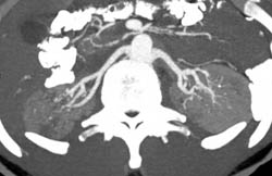 Polyarteritis Nodosa - CTisus CT Scan