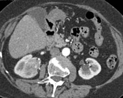 Transitional Cell Cancer (TCC) of Right Kidney With Multiple Sequences - CTisus CT Scan