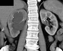 Ureteropelvic Junction (UPJ) With Delayed Function - CTisus CT Scan