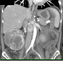 Renal Cell Carcinoma With Vascular Liver Metastases - CTisus CT Scan