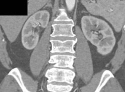 S/P Cystoprostatectomy With 2cm Pelvic Recurrance - CTisus CT Scan