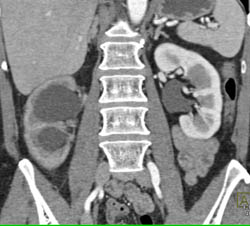 Obstructed Right Kidney Due to Stone - CTisus CT Scan