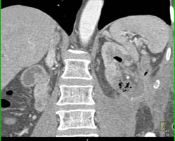 Renal Abscess and Abdominal Wall Abscess S/P Procedure - CTisus CT Scan