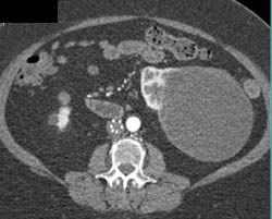 Cystic Lesion With Tumor Nodules in Wall - CTisus CT Scan