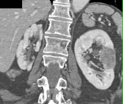 Renal Cell Carcinoma - CTisus CT Scan