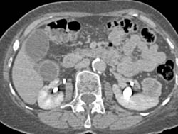 Renal Cell Carcinoma - CTisus CT Scan