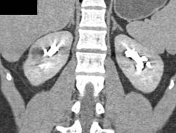 Complex Cyst - CTisus CT Scan