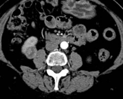 Renal Cell Carcinoma - CTisus CT Scan