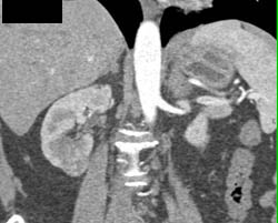 Subtle 2 Cm Renal Cell Carcinoma (RCC) Lower Pole Right Kidney - CTisus CT Scan