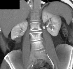 Prior Right Partial Nephrectomy - CTisus CT Scan