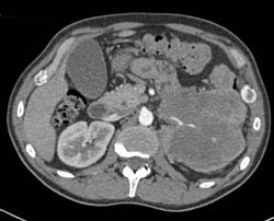 Cystic and Necrotic Renal Cell Carcinoma (RCC) Infiltrate the Left Kidney - CTisus CT Scan