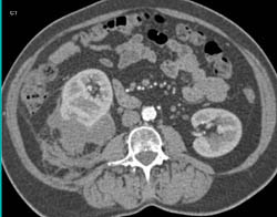 Perirenal Blood - CTisus CT Scan