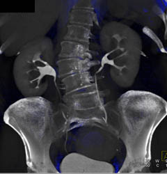 Normal CT Urogram - CTisus CT Scan