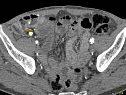 Transitional Cell Cancer (TCC) Right Ureter - CTisus CT Scan
