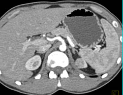 1 Cm Renal Cell Carcinoma (RCC) Upper Pole Left Kidney in Multiple Views - CTisus CT Scan