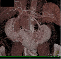 Horseshoe Kidney - CTisus CT Scan