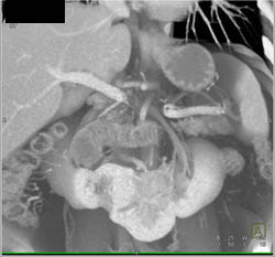 Horseshoe Kidney - CTisus CT Scan