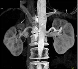 Right Renal Artery Aneurysm - CTisus CT Scan