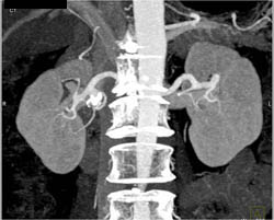 Right Renal Artery Aneurysm - CTisus CT Scan