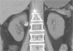 Right Renal Artery Aneurysm - CTisus CT Scan