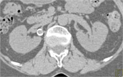 Right Renal Artery Aneurysm - CTisus CT Scan