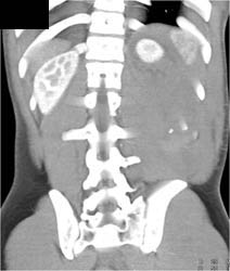 Huge Perirenal Bleed With Active Extravasation - CTisus CT Scan