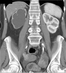 Hydronephrotic Right Kidney - CTisus CT Scan