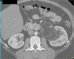 Renal Angiomyelolipoma - CTisus CT Scan