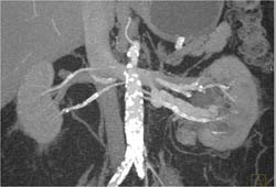 Av Shunting - CTisus CT Scan