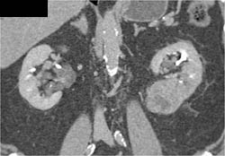 Renal Cell Carcinoma - CTisus CT Scan