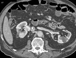 Renal Cell Carcinoma - CTisus CT Scan