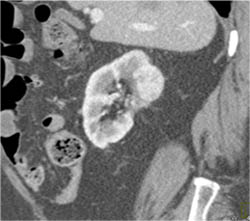 Renal Cell Carcinoma - CTisus CT Scan