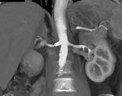 Patent Stent in the Right Renal Artery - CTisus CT Scan