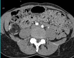 Renal Angiomyolipoma (AML) - CTisus CT Scan