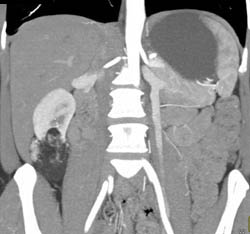 Renal Angiomyolipoma (AML) - CTisus CT Scan