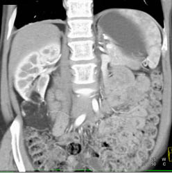 Renal Angiomyolipoma (AML) - CTisus CT Scan