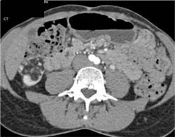 Renal Angiomyolipoma (AML) - CTisus CT Scan