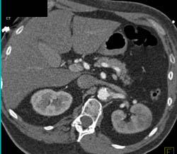 Aortic Dissection With Decreased Function Left Kidney - CTisus CT Scan