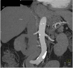 Renal Artery Stenosis - CTisus CT Scan