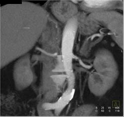 Renal Artery Stenosis - CTisus CT Scan