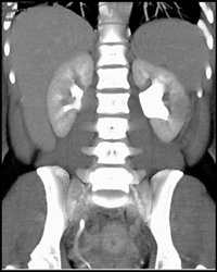 Acute Pyelonephritis - CTisus CT Scan