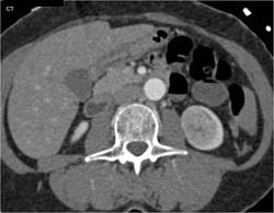 Left Renal Cell Carcinoma - CTisus CT Scan