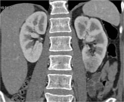 Left Renal Cell Carcinoma - CTisus CT Scan