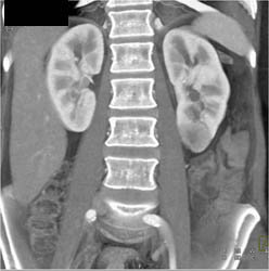 Left Renal Cell Carcinoma - CTisus CT Scan