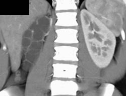 Chronic Ureteropelvic Junction (UPJ) Right Kidney - CTisus CT Scan