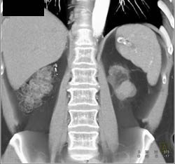 Renal Cell Carcinoma in End Stage Renal Disease (ESRD) in Patient With A Renal Transplant - CTisus CT Scan