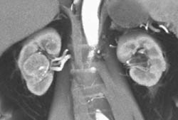 Renal Cell Carcinoma - CTisus CT Scan