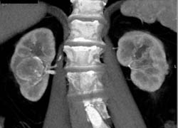 Renal Cell Carcinoma - CTisus CT Scan