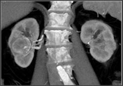 Renal Cell Carcinoma - CTisus CT Scan